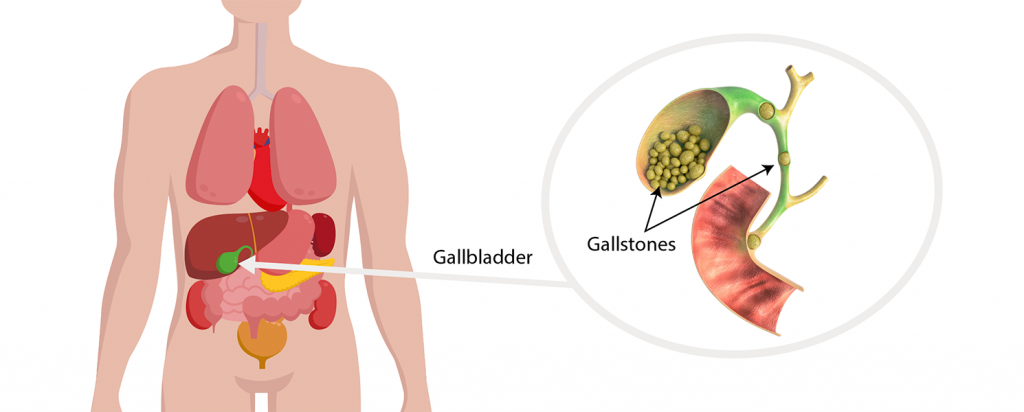 Gallstones discount