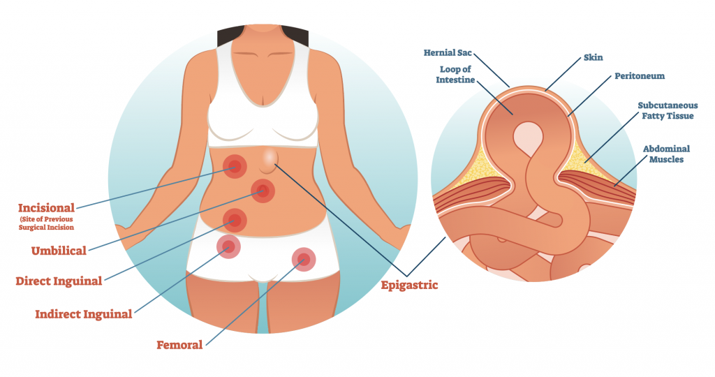 Hernia Surgery - Harbour Surgery Centre